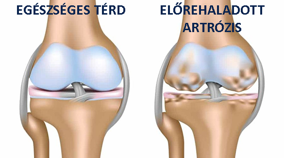 a lábak görbülése térd artrózissal